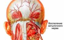 Неврит затылочного нерва