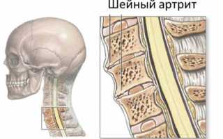 Артрит шейного отдела позвоночника лечение
