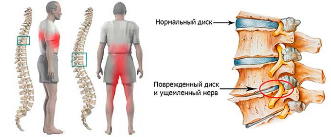 Присутствует ли взаимосвязь двух состояний? Остеохондроз