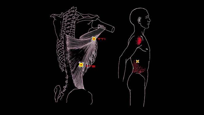 ÁÎËÈÒ ÑÏÈÍÀ  ÎÁËÀÑÒÈ ËÎÏÀÒÊÈ: øèðî÷àéøàÿ ìûøöà ñïèíû Çäîðîâüå, Ìåäèöèíà, Àíàòîìèÿ, Ñïîðò, Ôèòíåñ, Âèäåî, Ãèôêà, Äëèííîïîñò