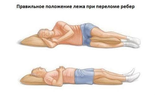 болит спина после перелома ребер