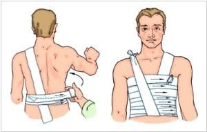 болит спина после перелома ребер