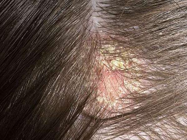 Красное пятнышко на голове болит голова