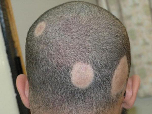 Красное пятнышко на голове болит голова