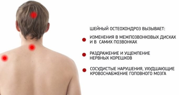 Последствия шейного остеохондроза Шейный остеохондроз