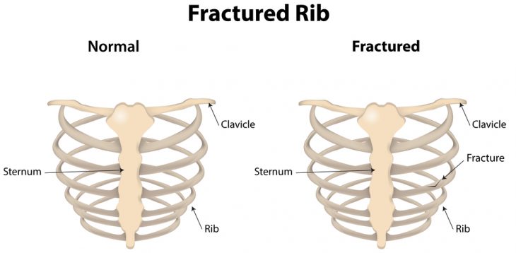 болит спина после перелома ребер