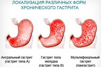 Формы гастритов