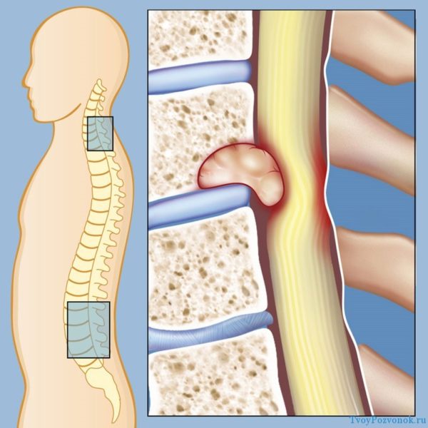 Появление кисты поясницы Появление кисты поясницы
