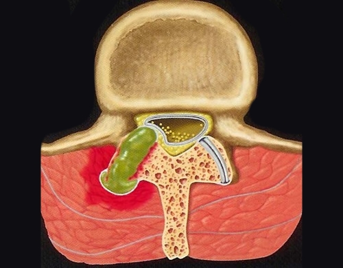 Периартикулярная киста позвоночника