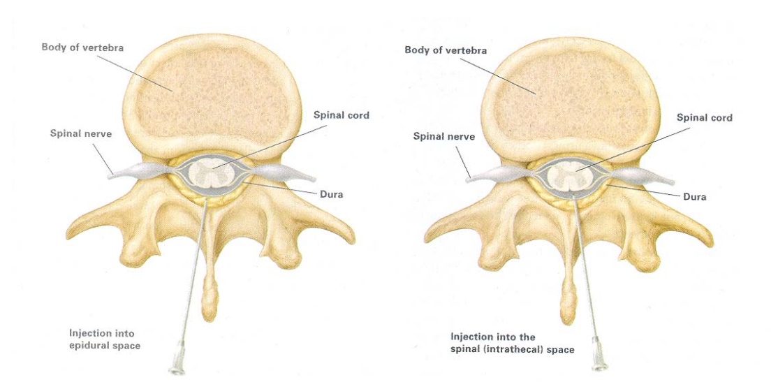 Слева – инъекция в эпидуральное пространство