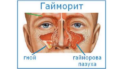 болит спина при температуре 38