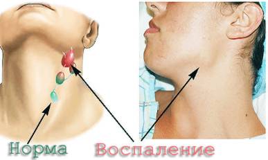 болит спина при температуре 38