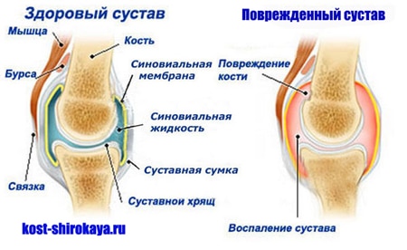 Почему болят колени,локти,плечи.Боль в суставах: что делать?