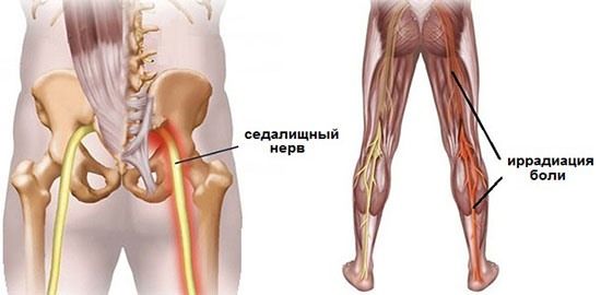 Седалищный нерв