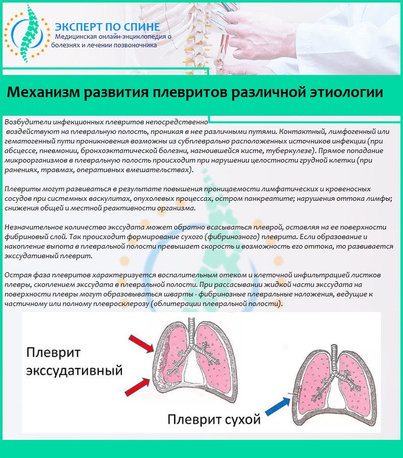 Механизм развития плевритов различной этиологии