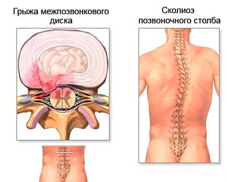 Боли в спине болит спина суставы лечение