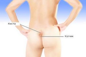 киста на спине болит