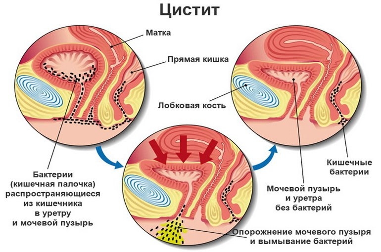 Почему при цистите болит спина