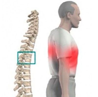 Грудной радикулит