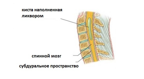 Возникновение кисты в спинном мозге Возникновение кисты в спинном мозге
