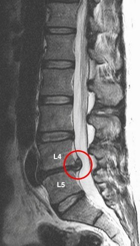 Болит сильно спина справа
