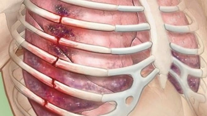 болит спина после перелома ребер