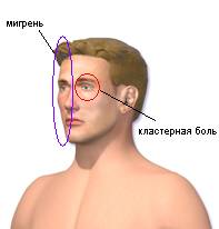 разница: мигрень и кластерная боль мигрень и кластерная боль