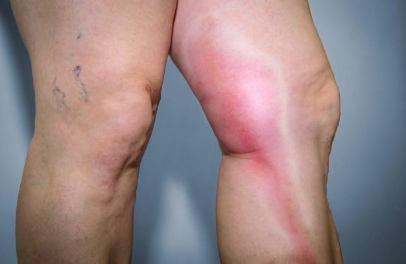 Осложнения при воспалении лимфоузлов на фоне простуды Осложнения при воспалении лимфоузлов на фоне простуды