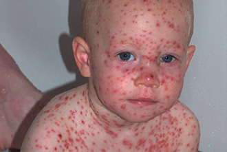 Ветрянка Ветряная сыпь